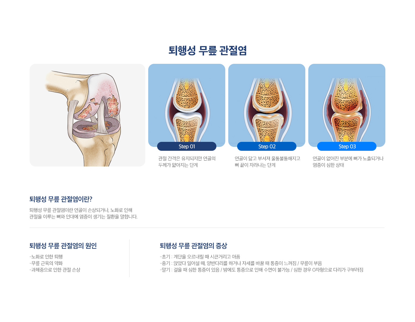 퇴행성 무릎 관절염